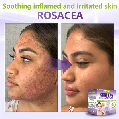 GFOUK® Soluble Microneedle Botanical Skin Tag Removal Patch🍇🍇🍇