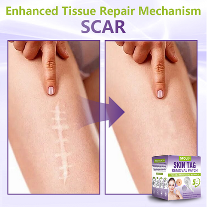 GFOUK® Soluble Microneedle Botanical Skin Tag Removal Patch🍇🍇🍇