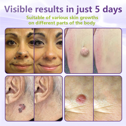 GFOUK® Soluble Microneedle Botanical Skin Tag Removal Patch🍇🍇🍇
