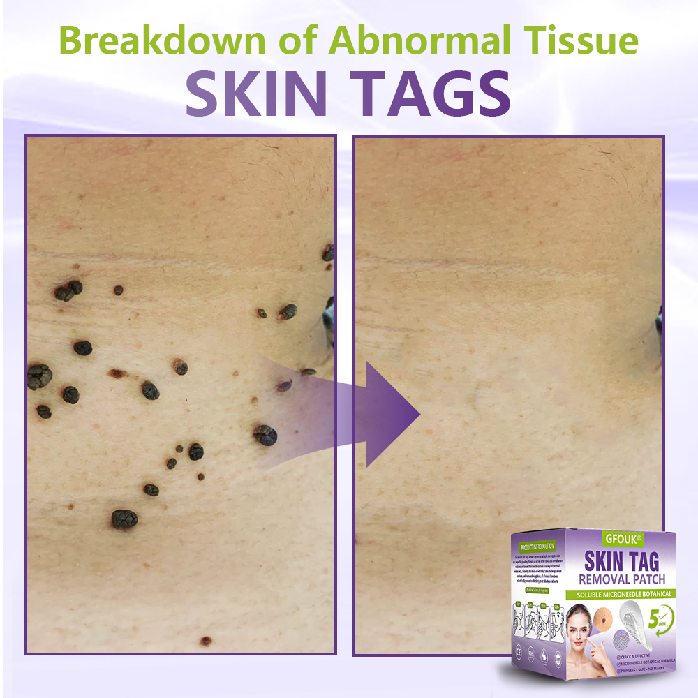 GFOUK® Soluble Microneedle Botanical Skin Tag Removal Patch🍇🍇🍇