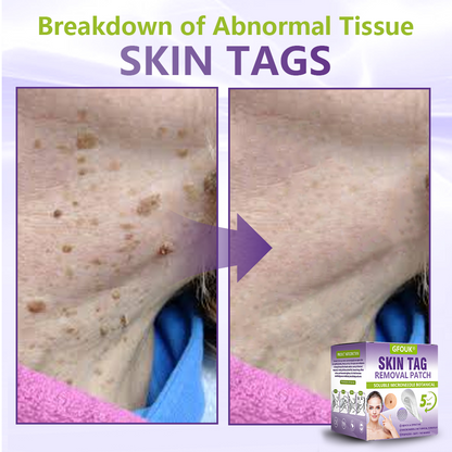 GFOUK® Soluble Microneedle Botanical Skin Tag Removal Patch🍇🍇🍇
