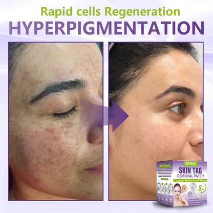 GFOUK® Soluble Microneedle Botanical Skin Tag Removal Patch🍇🍇🍇