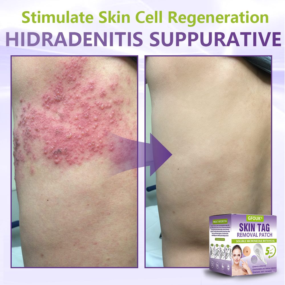 GFOUK® Soluble Microneedle Botanical Skin Tag Removal Patch🍇🍇🍇