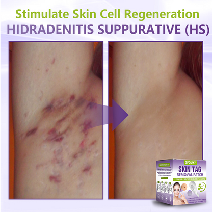 GFOUK® Soluble Microneedle Botanical Skin Tag Removal Patch🍇🍇🍇